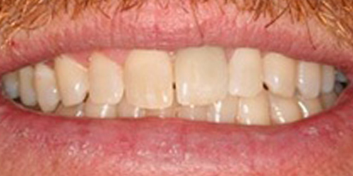 Closed gap between front teeth