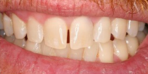 Gapped front teeth
