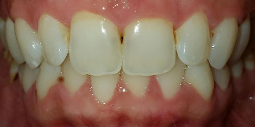 Yellowed teeth