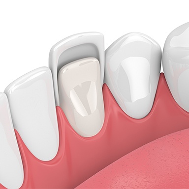 Animation of porcelain veneer placement