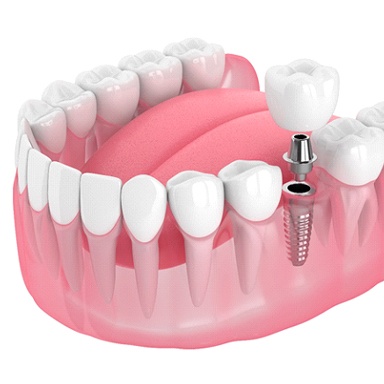 A diagram of a dental implant.