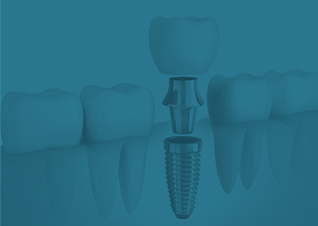 Animaiton of implant supported dental crown palcement