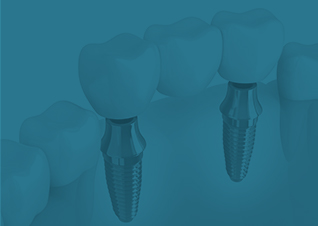 Animation of implant supported fixed bridge placement