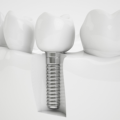 Animation of implant supported dental crown