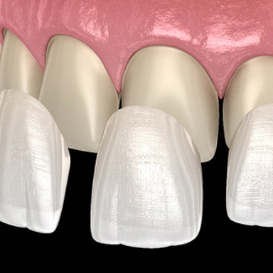 Veneers on teeth