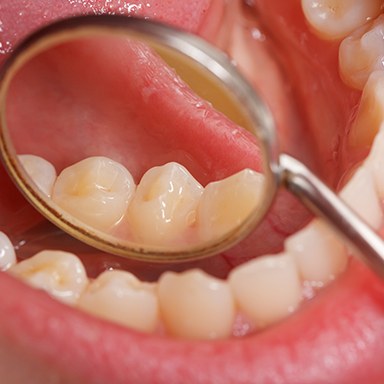 Closeup of tooth with a dental filling