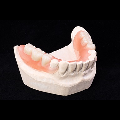 Model smile with partial denture