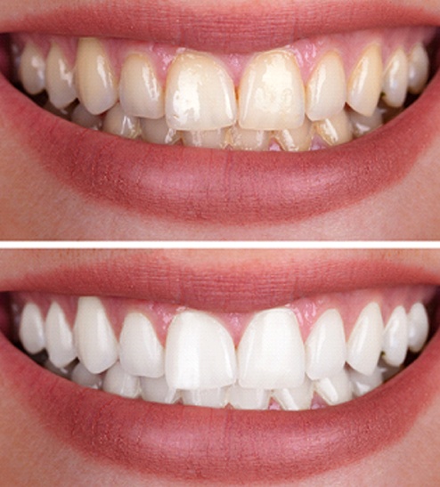 Teeth Whitening